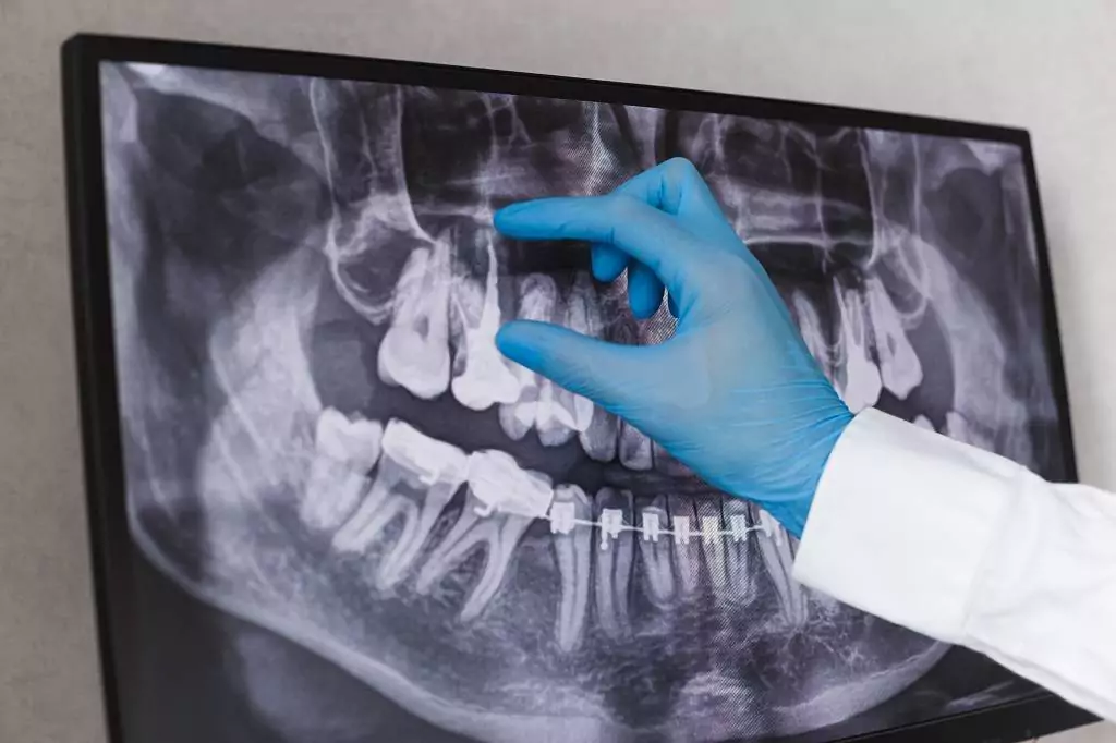 What Is a Dental Root Canal Treatment?​