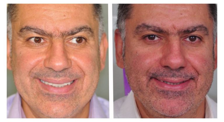 Smile Design Cosmetic Treatment