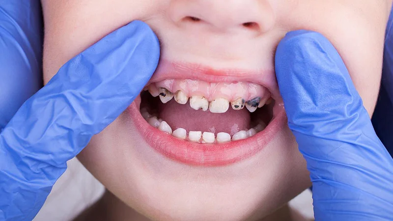 treatment for tooth decay in child: how to stop tooth decay from spreading