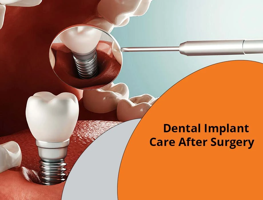 dental implants care after surgery