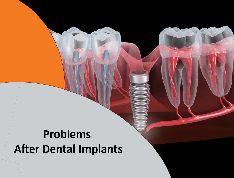 common problems after dental implants