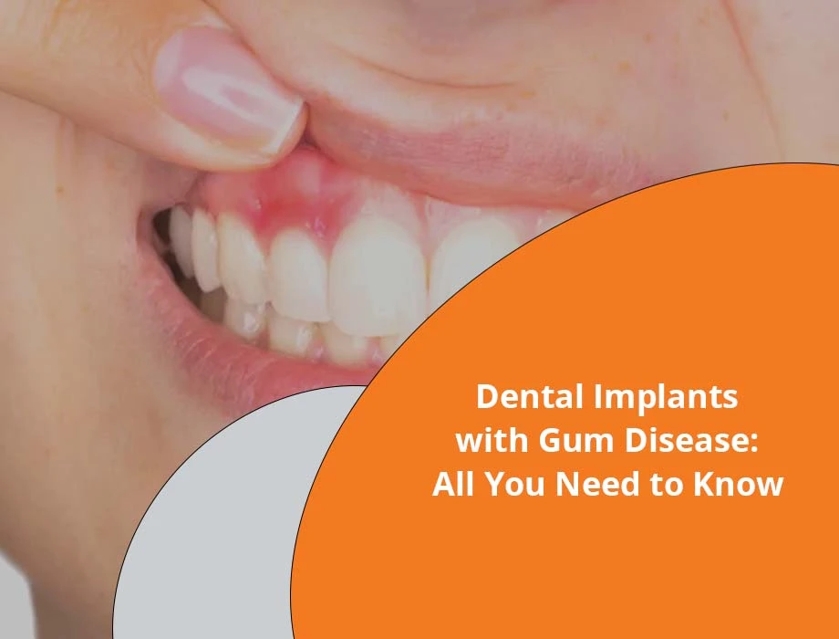 dental implants with gum disease