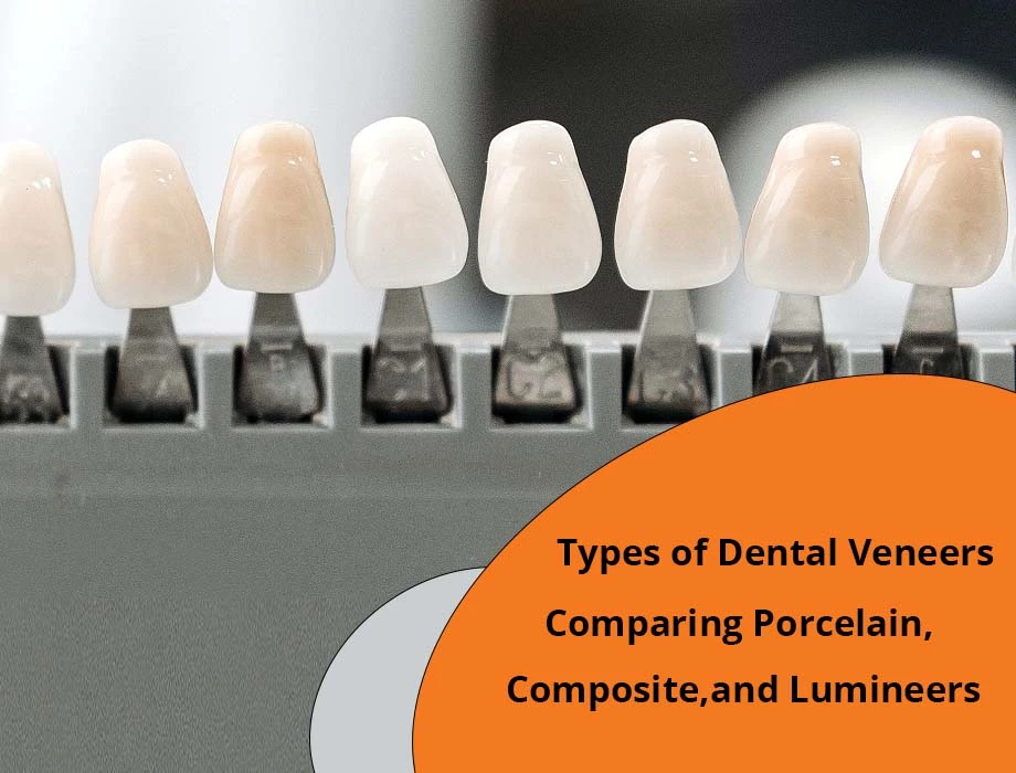 types of dental veneers